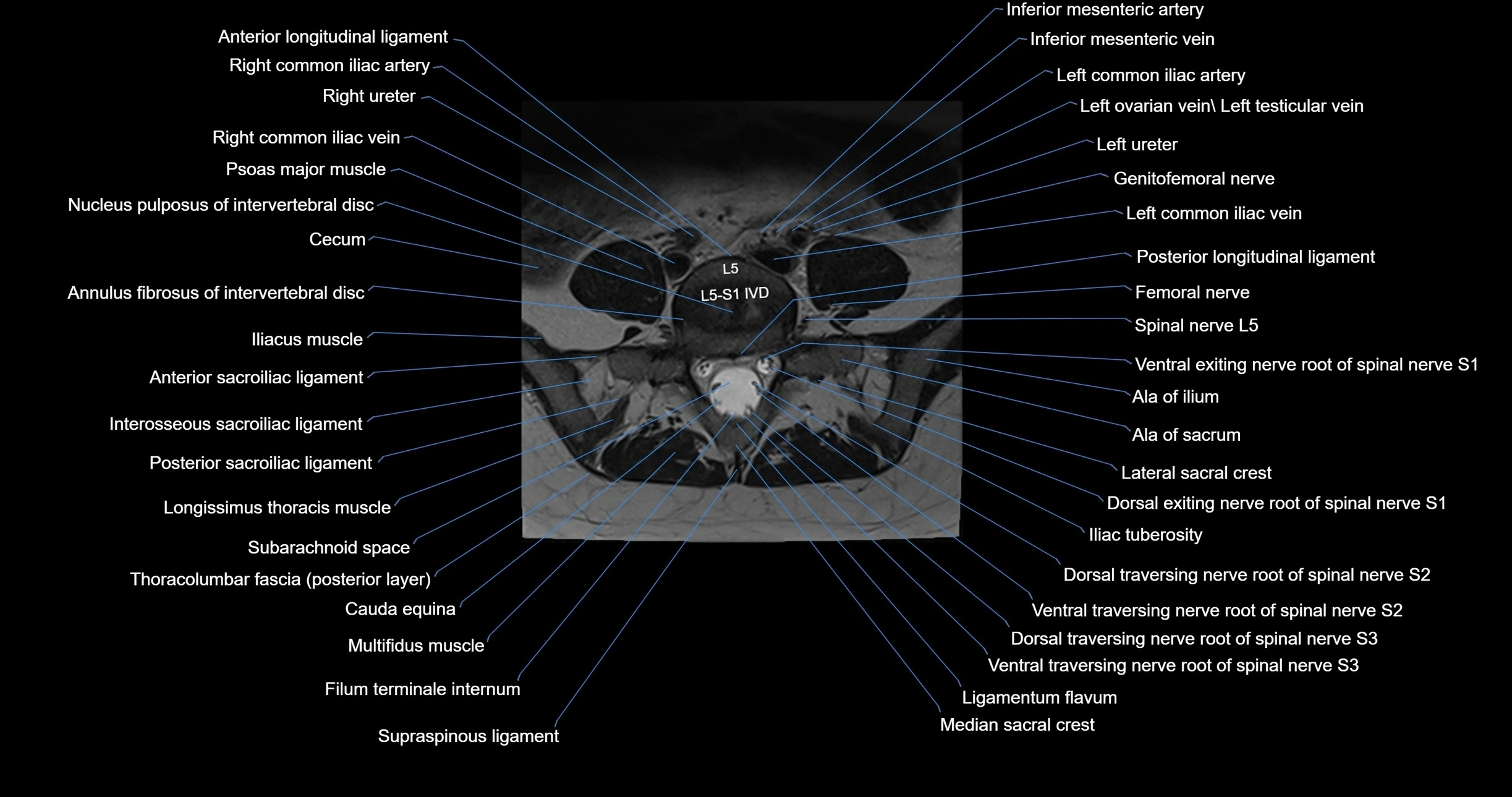 MRI lumbar spine axial cross sectional anatomy 3T radiology  image-img-00001-00042.webp